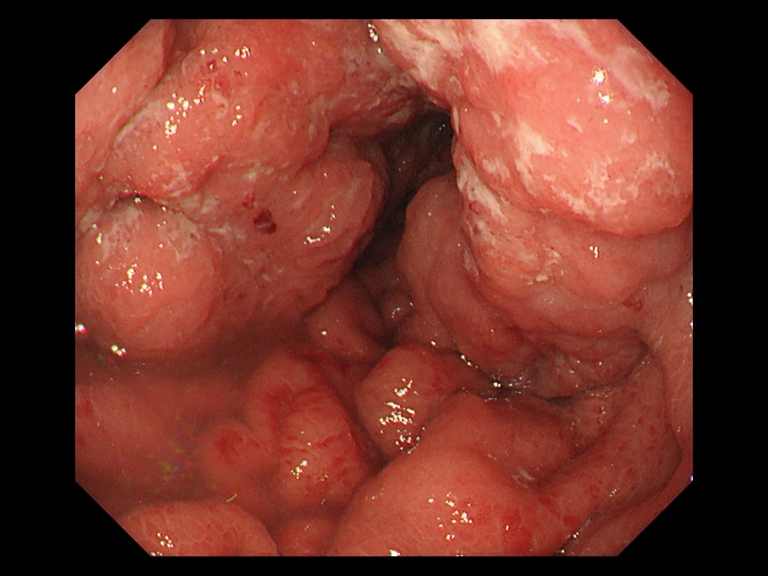 胃がんの症例写真と解説 夙川内視鏡内科まえだクリニック 西宮市で痛くない胃カメラ 下剤を飲まない大腸カメラを土曜日曜も実施