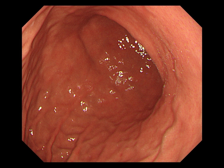 胃がんの症例写真と解説 夙川内視鏡内科まえだクリニック 西宮市で痛くない胃カメラ 下剤を飲まない大腸カメラを土曜日曜も実施