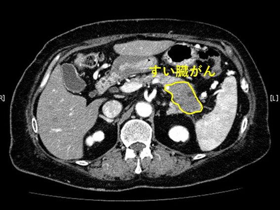 すい臓がんの症例写真と解説   夙川内視鏡内科まえだクリニック西宮